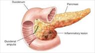 پاورپوینت پانکراتیت Pancreatitis